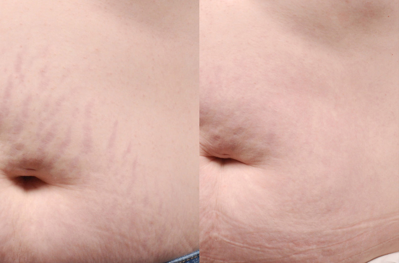 Before and After Scar Removal
