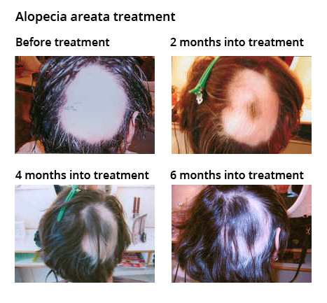 New Man Clinic - case study - Alopecia areata treatment using Kapyderm natural products