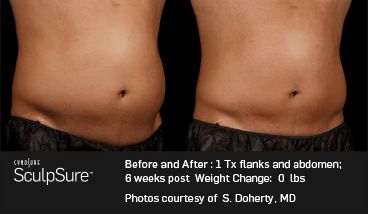 SculpSure: Before & After