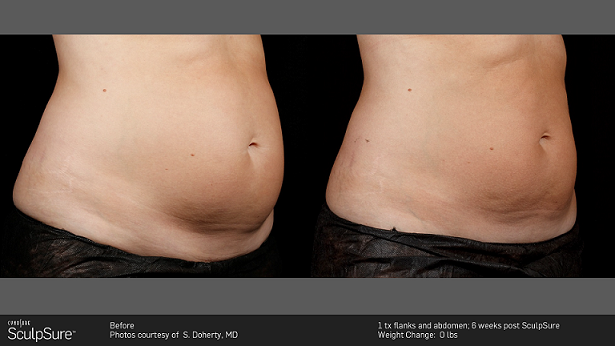 SculpSure: Before & After