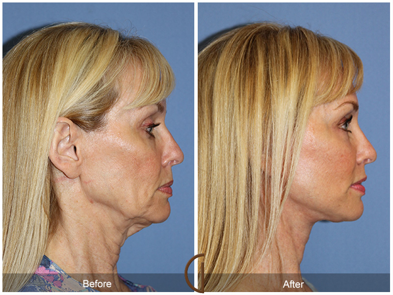 Lower Face & Neck Lift - Natural, Long Lasting Results with Local Anesthesia and Twilight Sedation