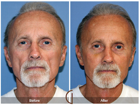 Before and after photo of facial fat grafting with PRP.  Treatment was used to restore lost facial volume due to aging in this male's face.