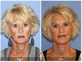 Lower Facelift & Neck Lift with Fat Grafting Performed with Local Anesthesia - No General Anesthesia Needed! Natural-looking, Long Lasting Results!