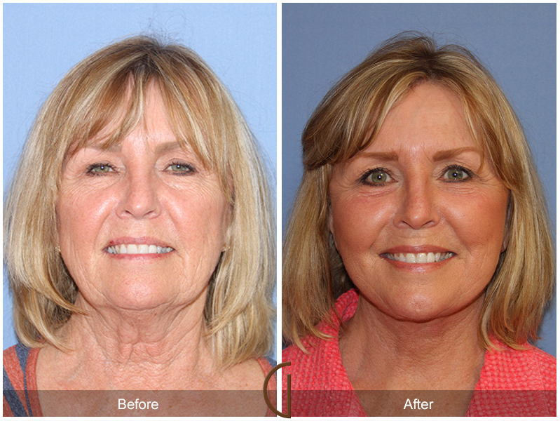 Lower Face & Neck Lift - By Orange County Facial Plastic Surgeon