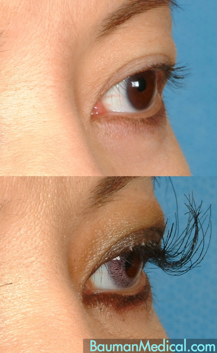 Eyelash Transplant before-and-after