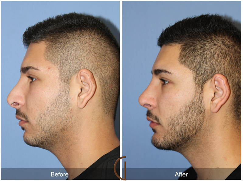 Male revision rhinoplasty and chin implant done by Newport Beach top facial plastic surgeon, Dr. Kevin Sadati.