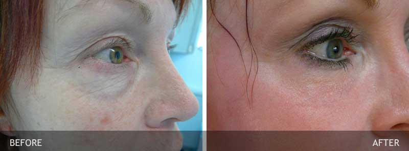 Before and After Juvederm OSR 2