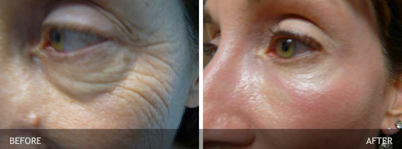 Before and After Juvederm OSR