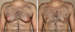 #Gynecomastia Before/After