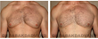 #Gynecomastia Before/After