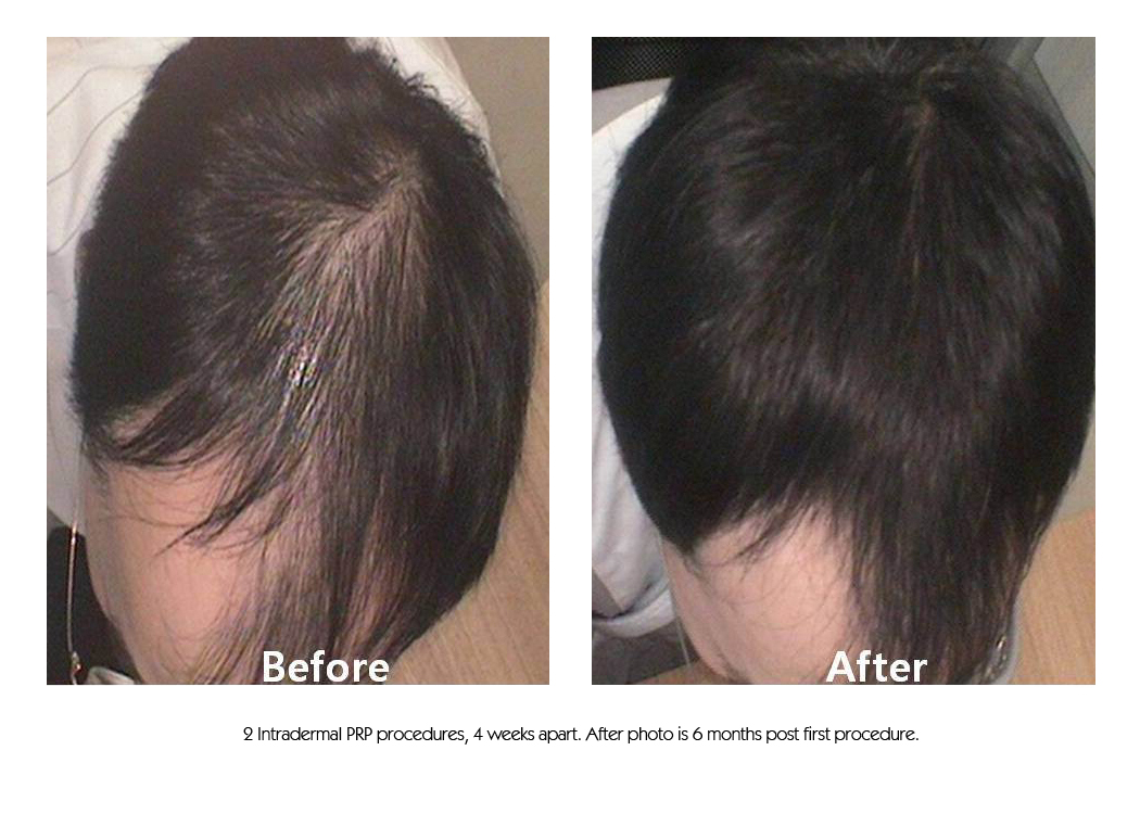 Scalp PRP Before & After