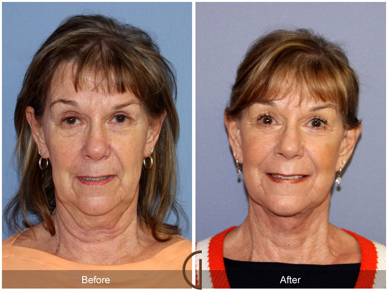 Neck Lift - No General Anesthesia