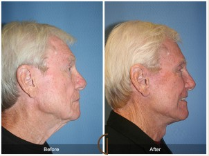 Male Neck Lift by Dr. Kevin Sadati, Orange County Top Cosmetic Surgeon
