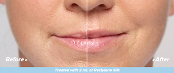 Restylane Silk