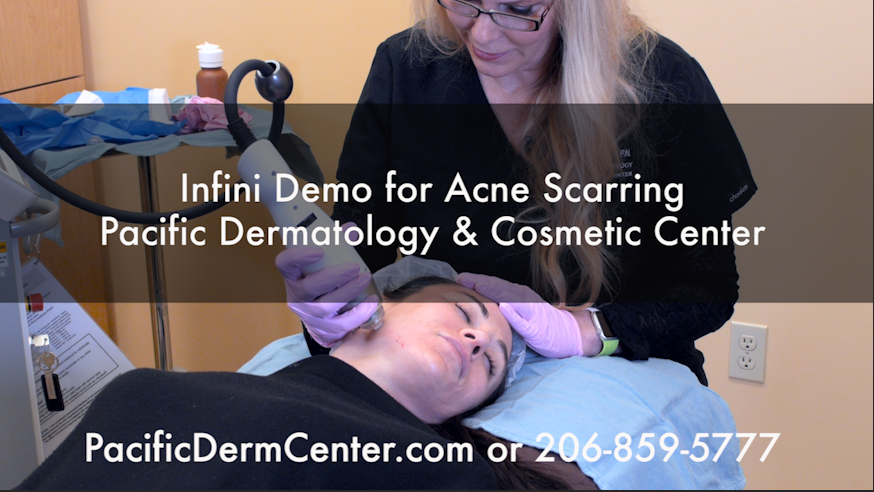 Infini™ Technology for Acne Scarring