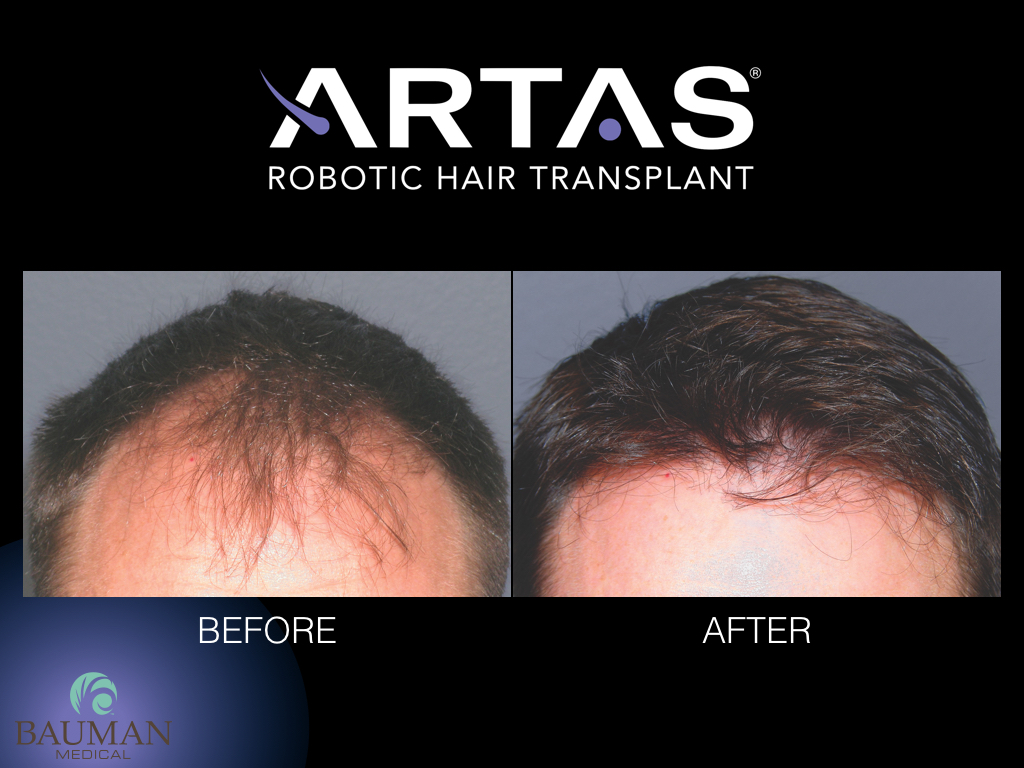 Before & After results for an ARTAS Robotic-assisted hair transplant procedure patient.