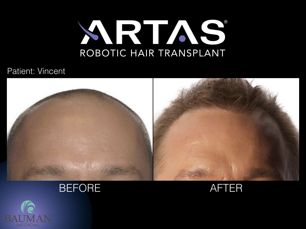 Before & After results for an ARTAS Robotic-assisted hair transplant procedure patient.