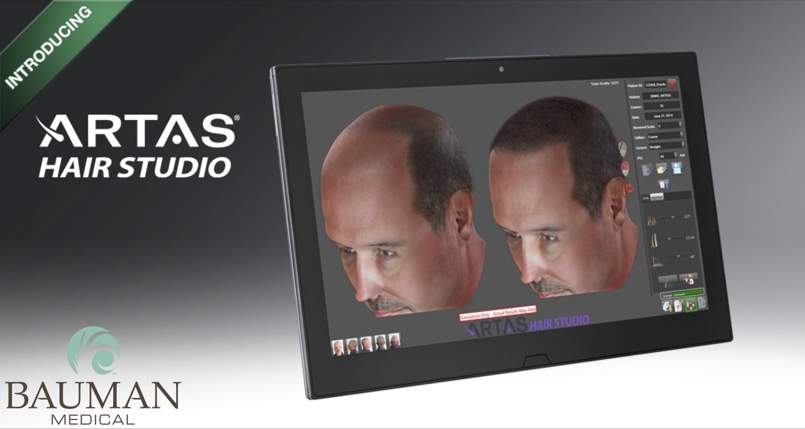 Now available at Bauman Medical in Boca Raton - ARTAS Robotic-assisted hair transplants.