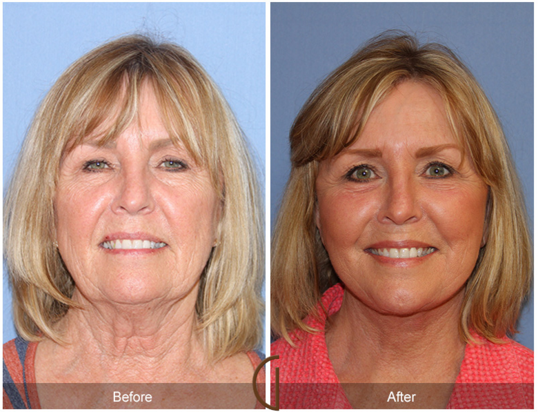 Facial Plastic Surgery Results from Board Certified Facelift Specialist, Dr. Kevin Sadati