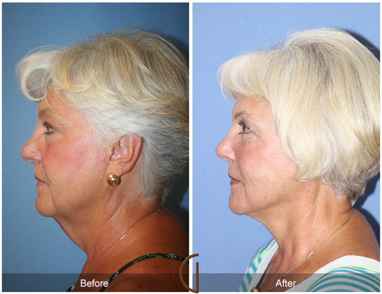Lower Facelift and Neck Lift Surgery by Dr. Kevin Sadati, Newport Beach Top Cosmetic Surgeon
