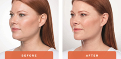 Kybella female patient before and after treatment picture
