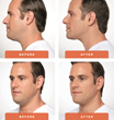 Kybella Treatment Male Before & Afters