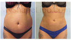 MyShape Lipo - Large Volume Liposuction to Abdomen 