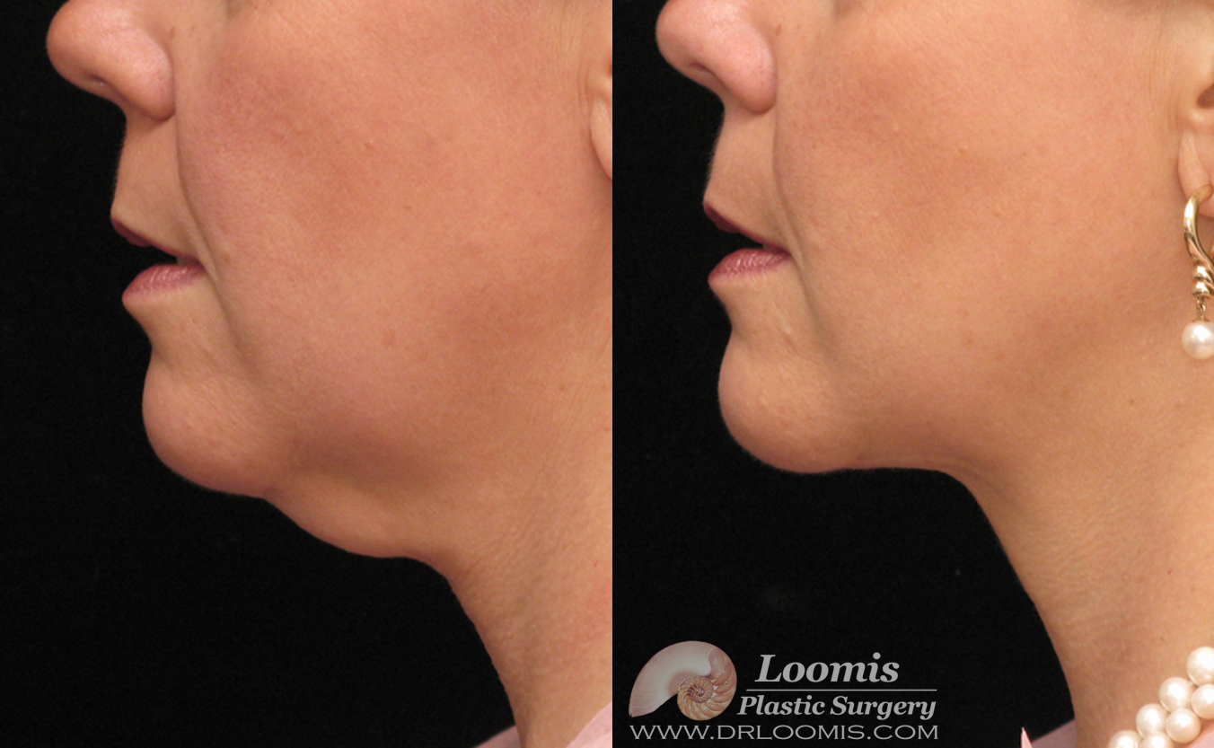 Loomis Plastic Surgery Mini Facelift (not a guarantee of results)