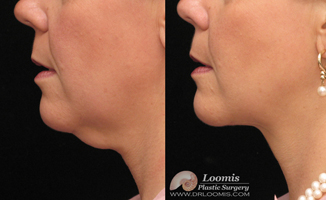 Loomis Plastic Surgery Mini Facelift (not a guarantee of results)