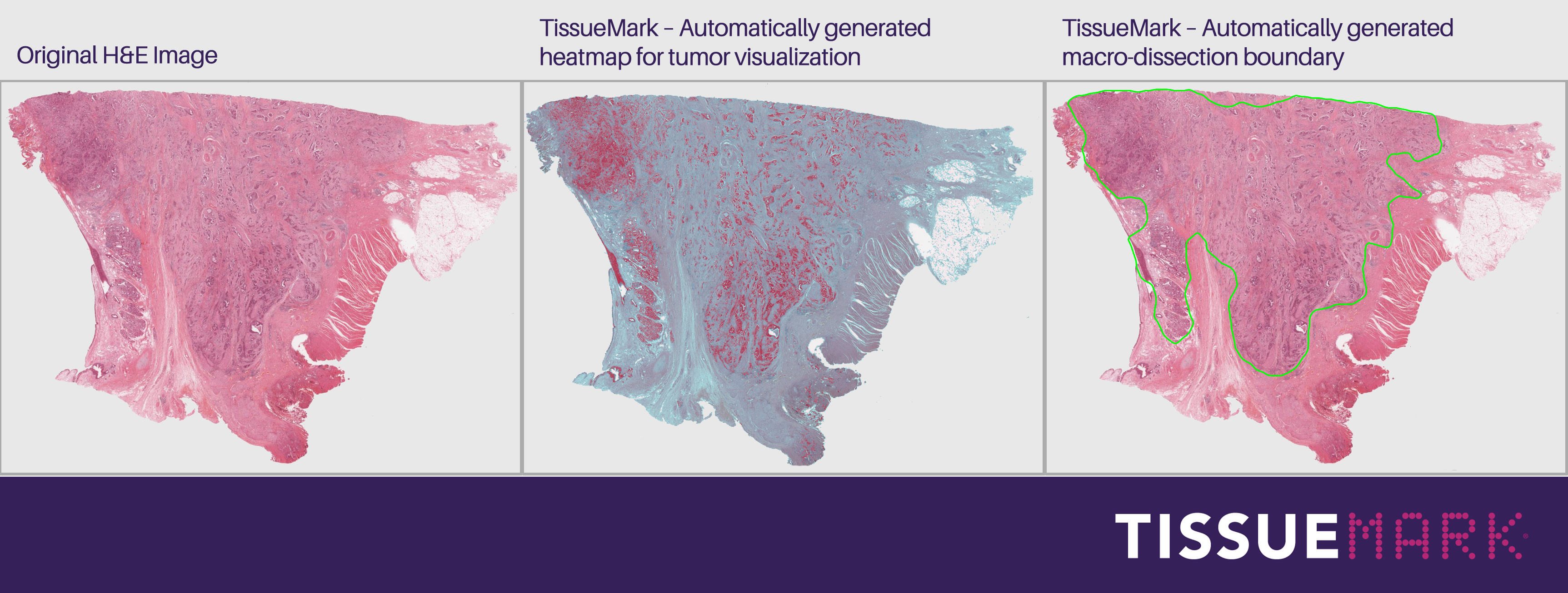 H&E virtual slide displayed next to TissueMark’s heatmap for tumor visualization and the automatically generated macro-dissection boundary