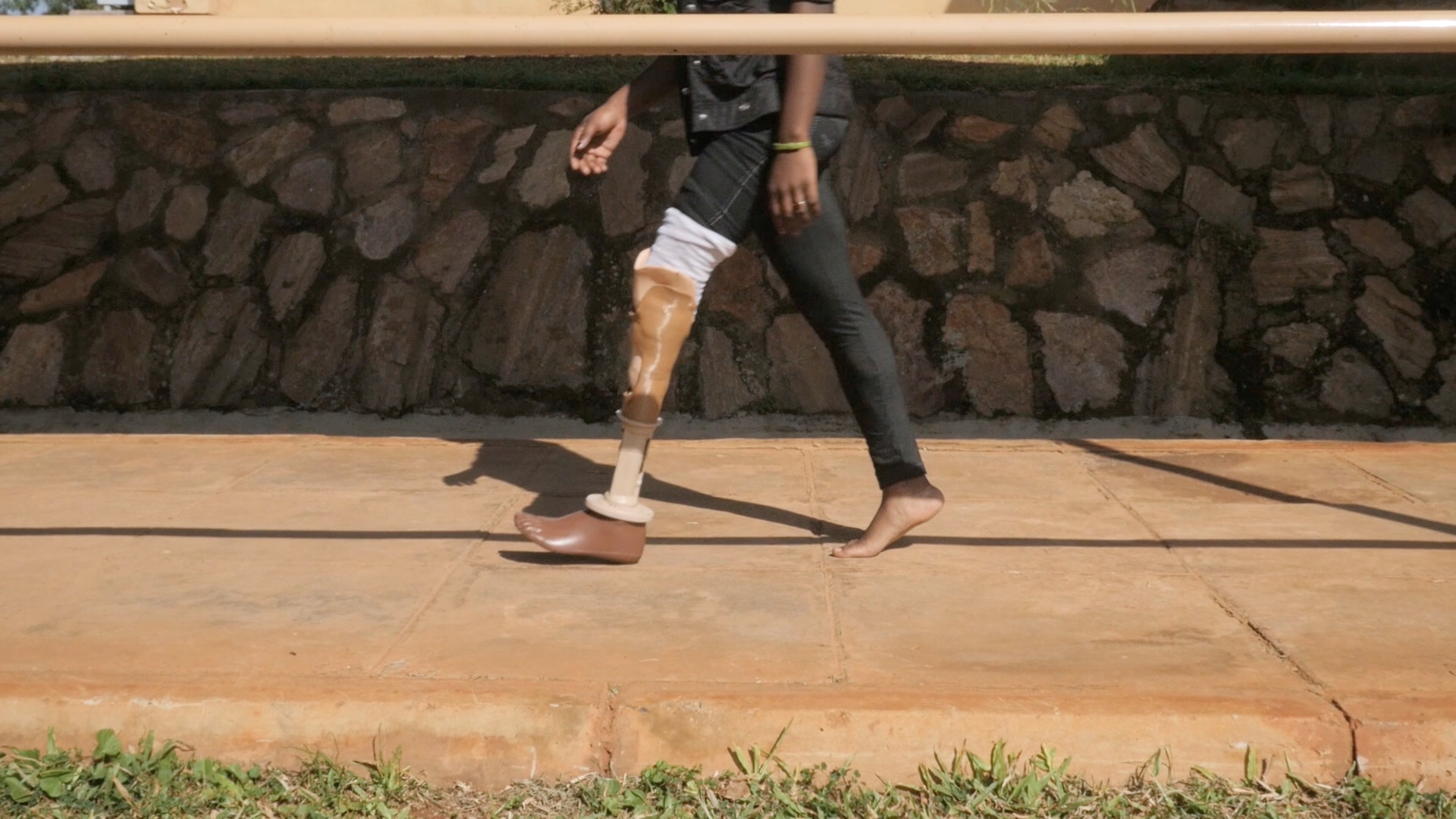 Youth patient tests out her new 3D PrintAbility lower limb socket.