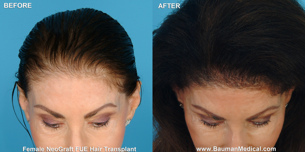 Female NeoGraft FUE Hair Transplant Patient