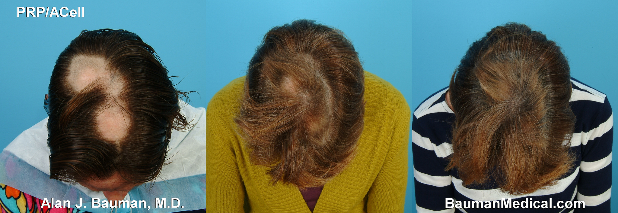 PRP Hair Regrowth - Alopecia Areata