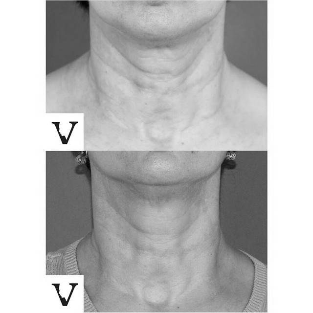 Before and After using MesoLyft NECK