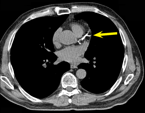 Coronary Calcium Scan 2