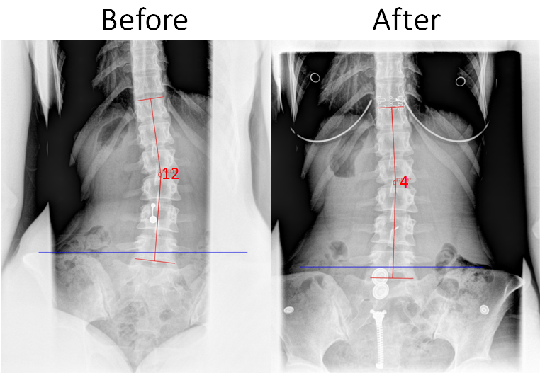Example of a patient who went through our 1-week Accelerated Scoliosis Care Program