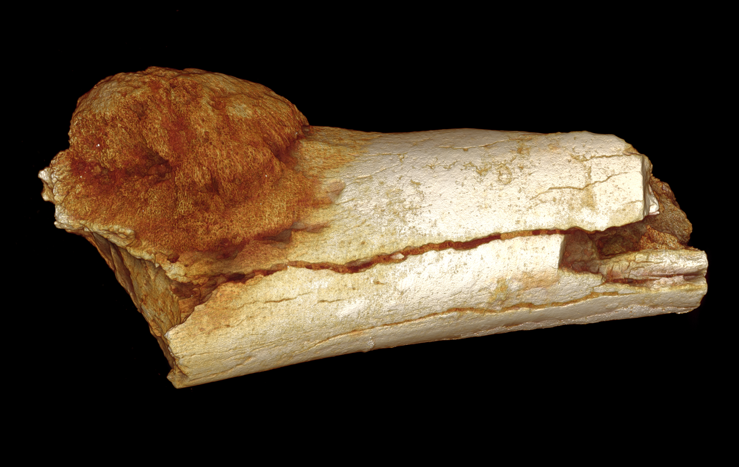 SK7923 fig 1. Metatarsal SK 7923. Volume rendered image of the external morphology of the foot bone, showing the extent of expansion of osteosarcoma (primary bone cancer) beyond the surface of the bon