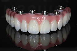 Full Arch Dental Implant Prettau Zirconia Bridge Teeth Tomorrow
