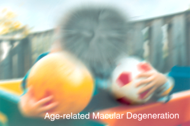Age-Related Macular Degeneration. A scene as it might be viewed by a person with age-related macular degeneration.