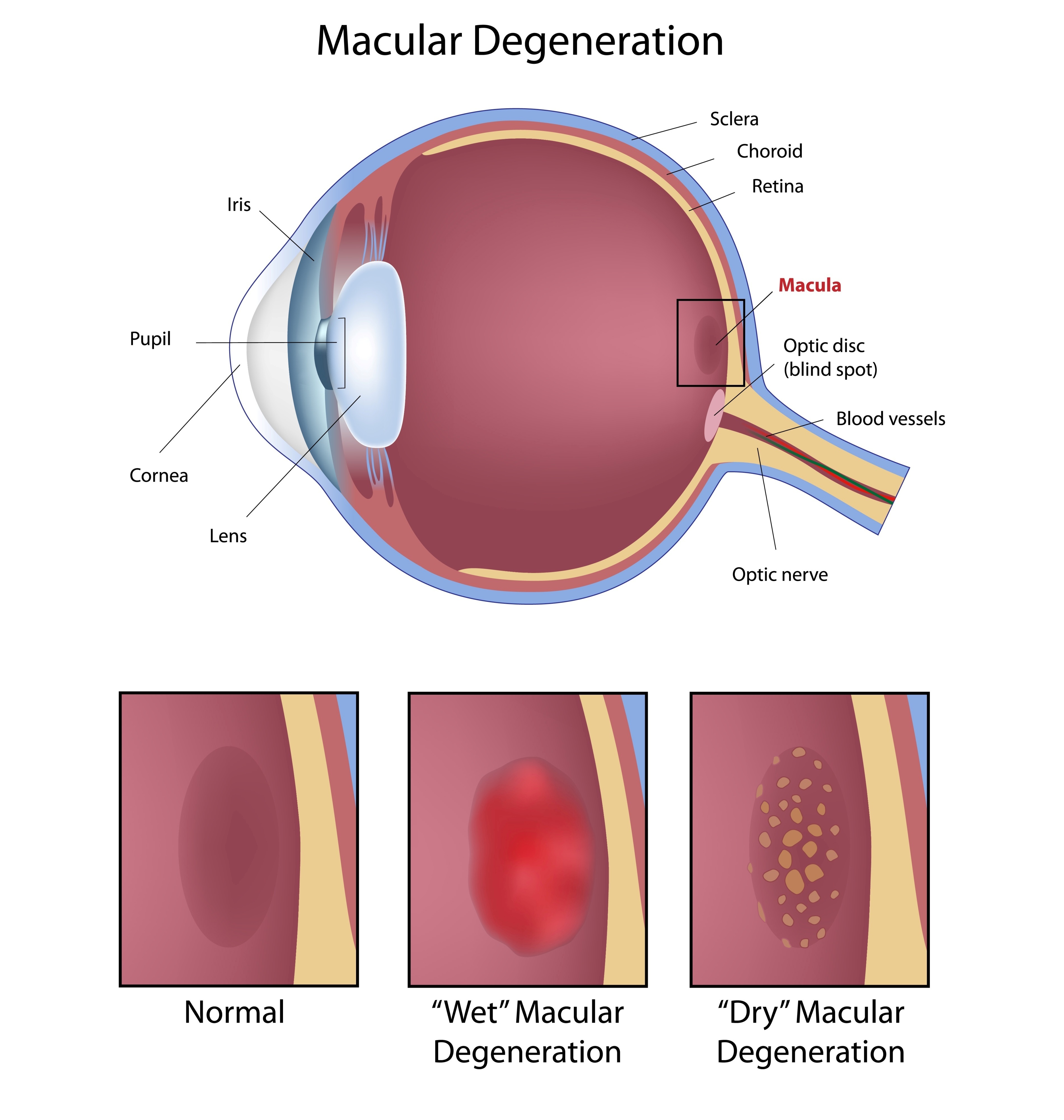 Macular Degeneration affects the central area of the retina responsible for sharp central vision needed for reading and seeing details.