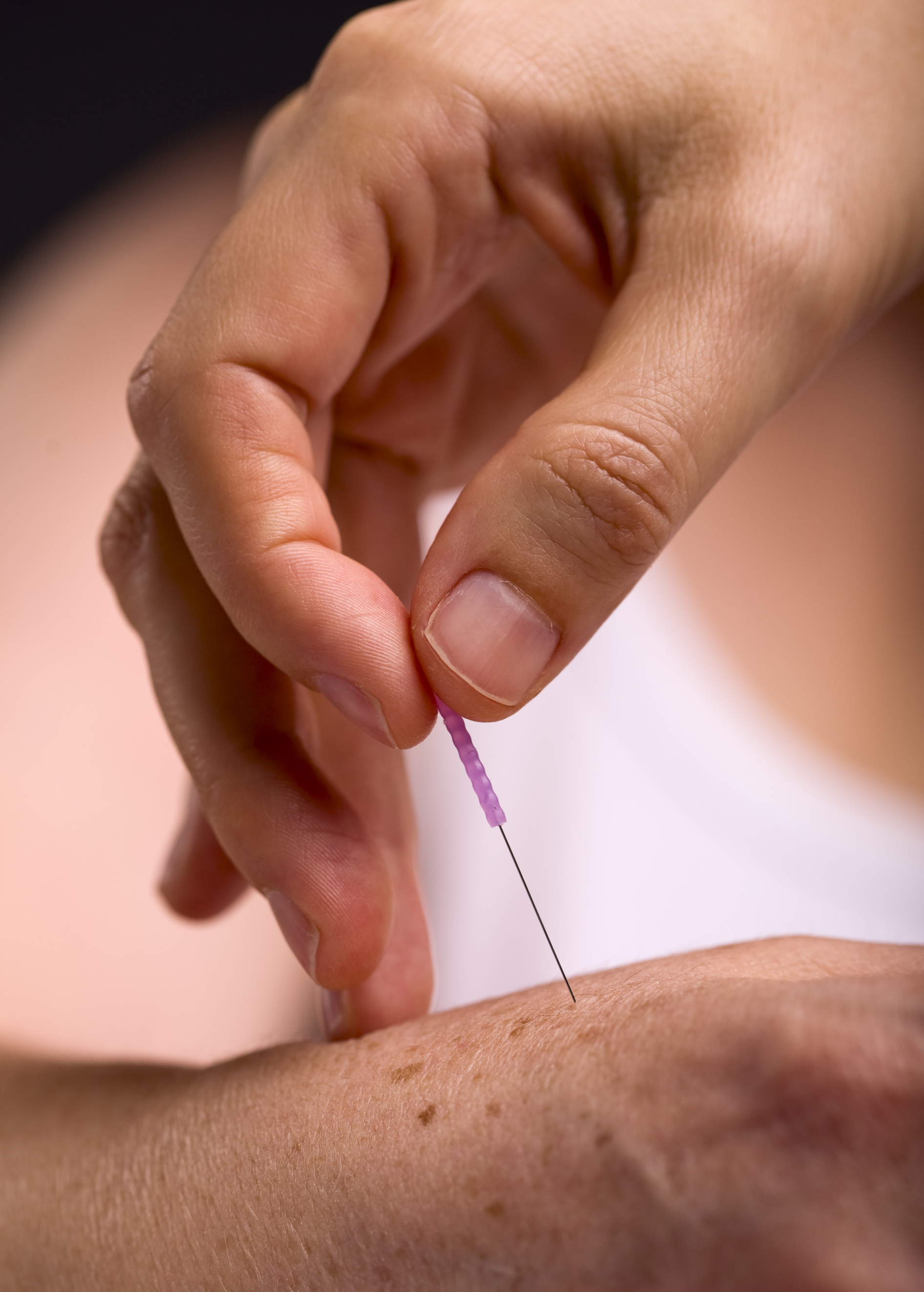 An acupuncturist carefully inserts a tiny needle.