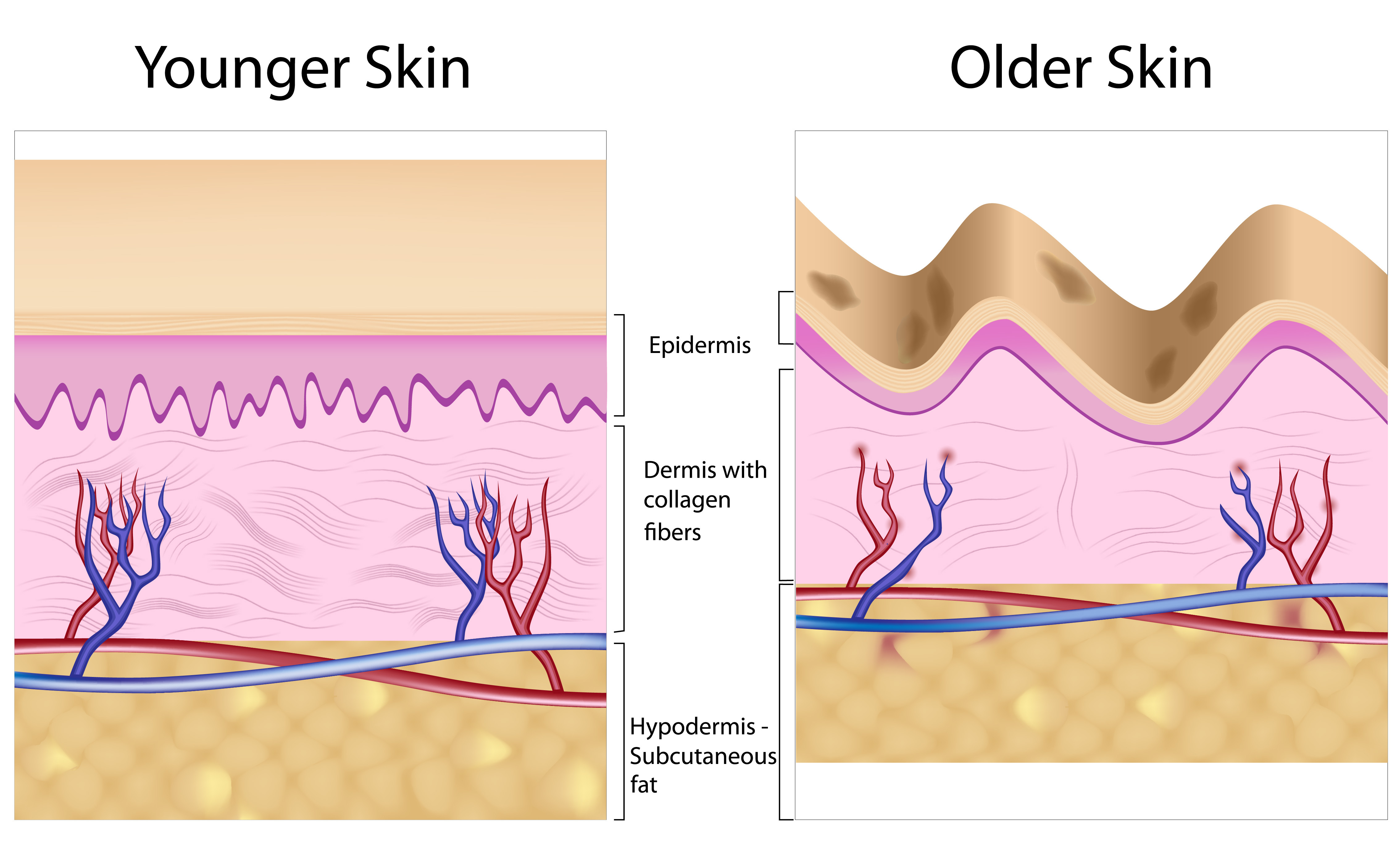 As people age, they lose the elasticity in their skin, causing it to sag.
