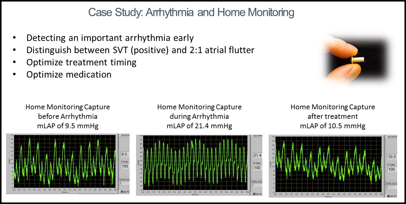 Case Study: Arrhythmia and Home Monitoring