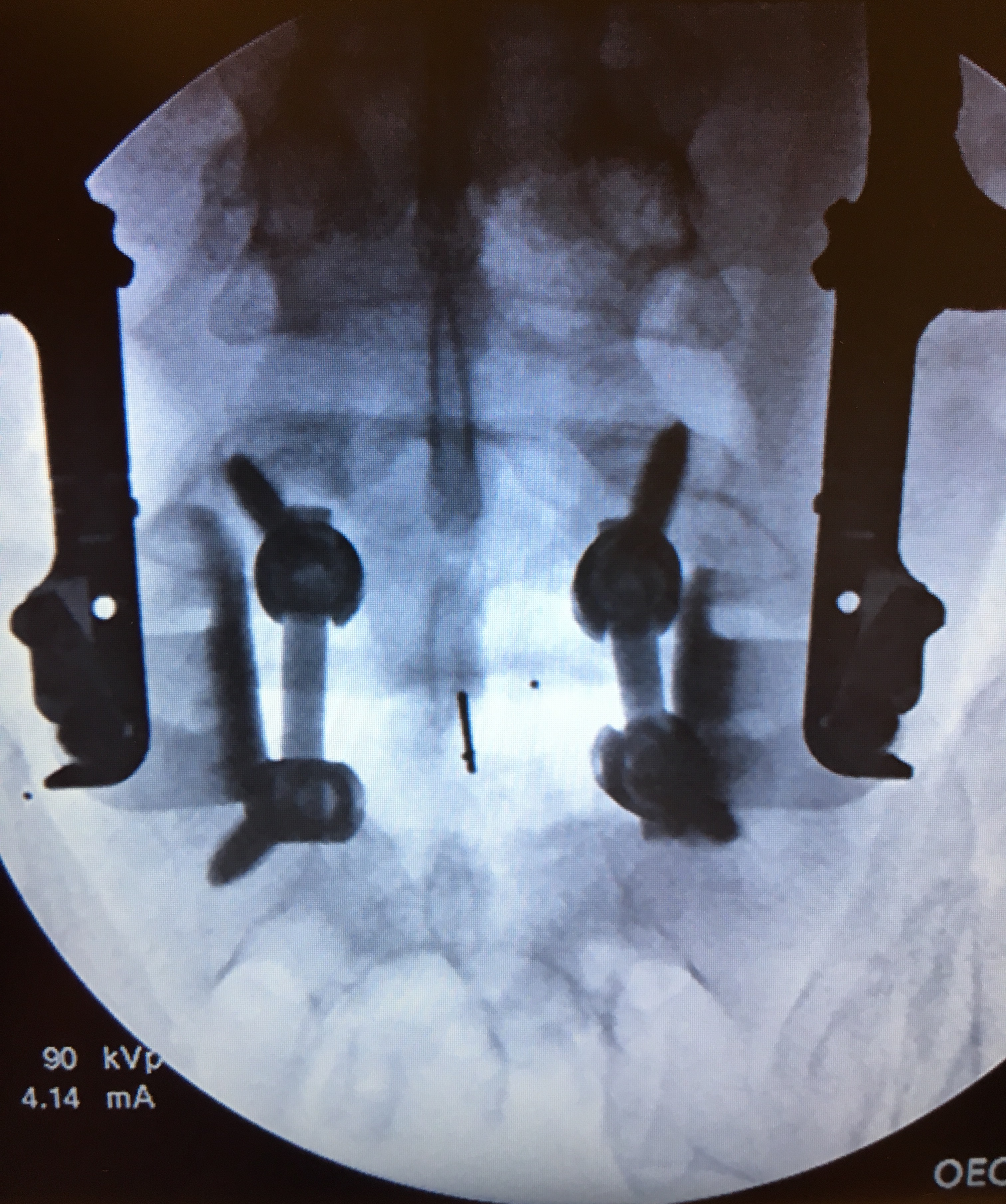 Final construct, with pedicle screws and PLIFT Implant