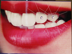 Dental Implants San Francisco Bay Area