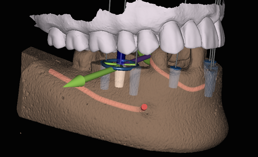 Cutting-edge 3-D implant placement