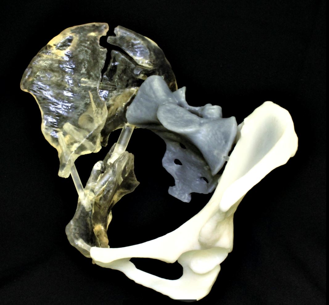 axial3D precise 3D printed pelvis that facilitated preoperative planning, reduced theatre times and improved the surgical outcome for patient.
