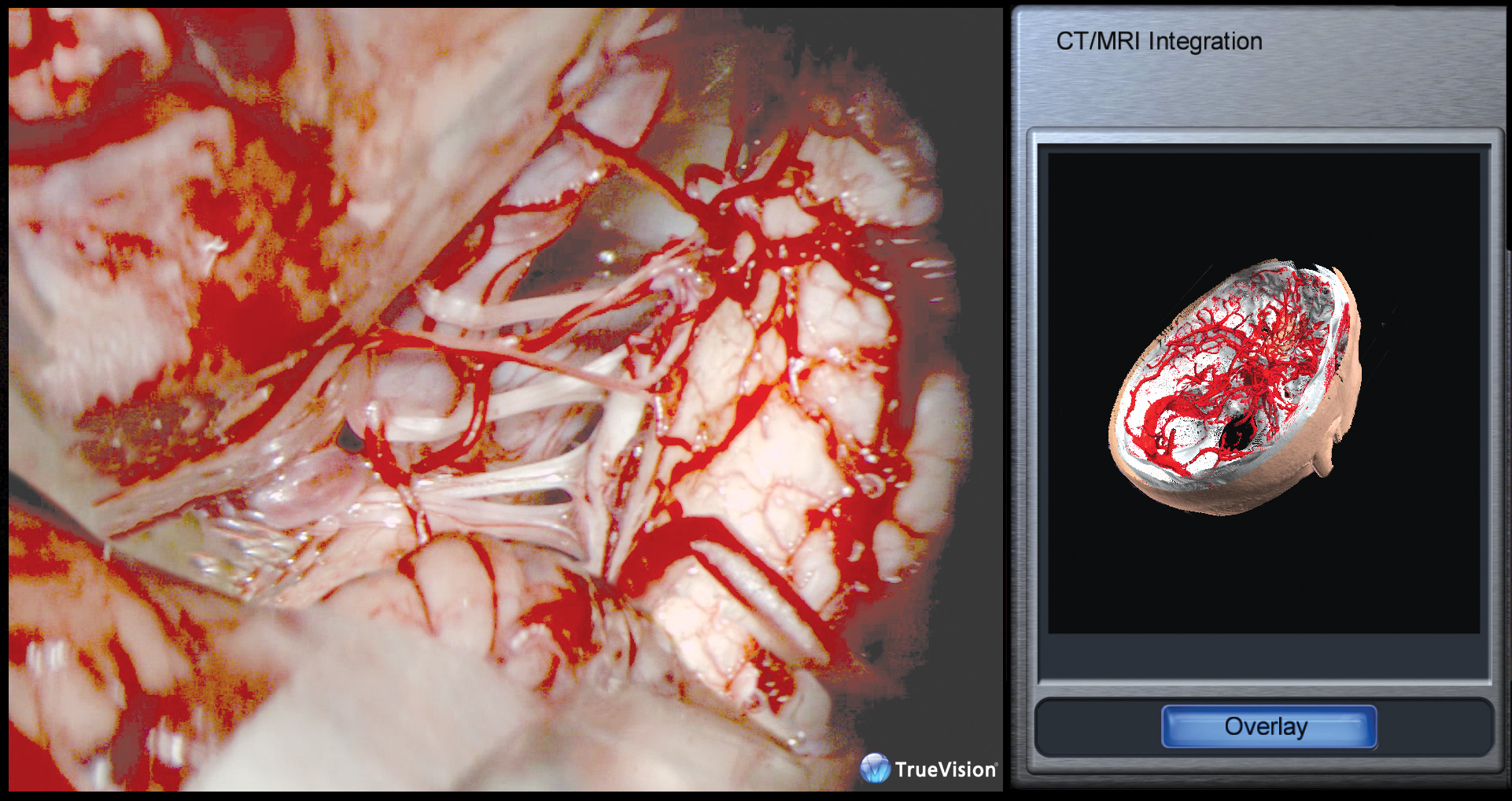 Overlay CT/MRI data into the surgical field real-time during surgical procedures