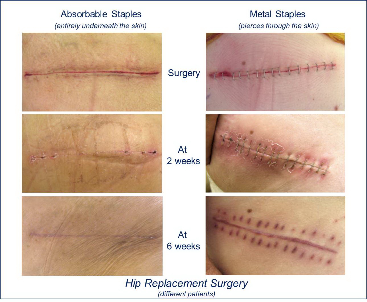 Comparison of INSORB Absorbable Staples vs. Metal Staples in Hip Replacement Surgery