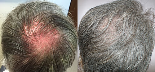 PRP is a great non-surgical hair restoration treatment!